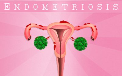 Why Weed is the Best Thing That’s Happened to Endometrosis Patients in the Last 50 Years